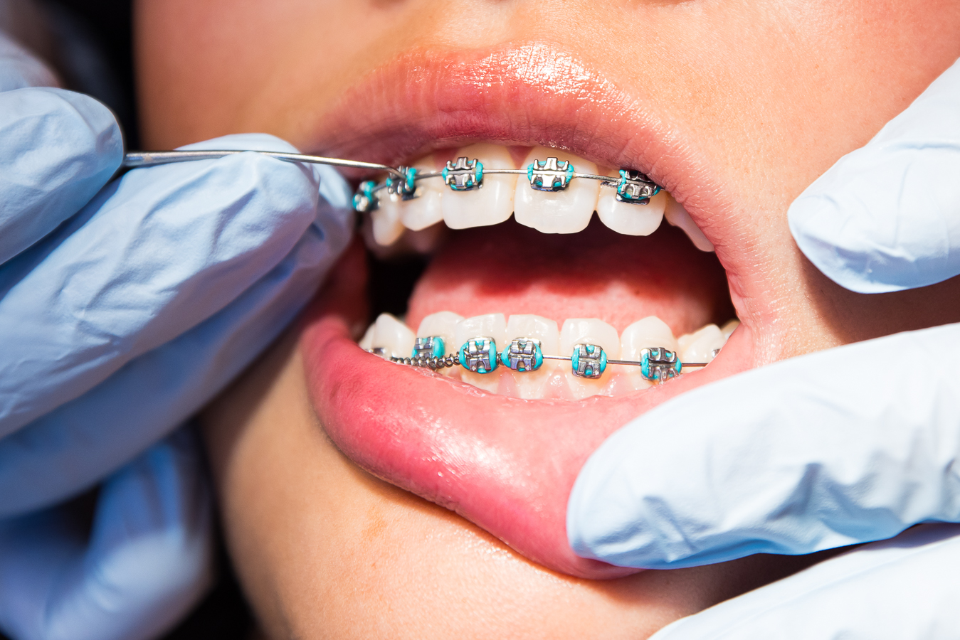 close up image of a patients teeth as the dental assistant works on tightening the teal colored braces during this branding photography session 